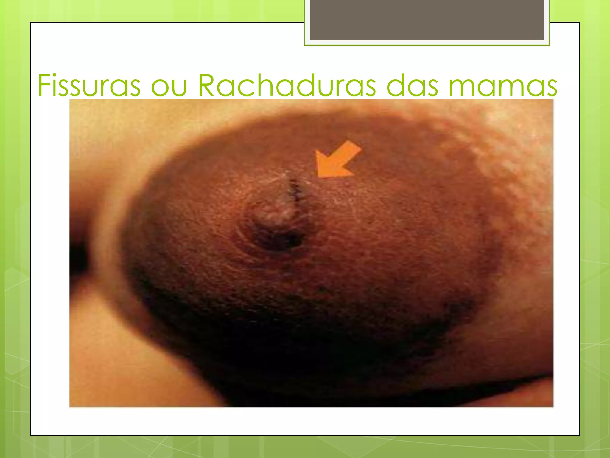 Fissuras ou Rachaduras das mamas
 