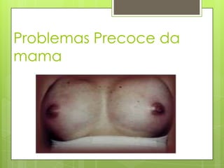 Problemas Precoce da
mama
 