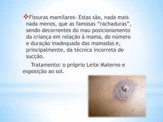 Fissuras mamilares- Estas são, nada mais
nada menos, que as famosas “rachaduras”,
sendo decorrentes do mau posicionamento
da criança em relação à mama, do número
e duração inadequada das mamadas e,
principalmente, da técnica incorreta de
sucção.
Tratamento: o próprio Leite Materno e
exposição ao sol.
 