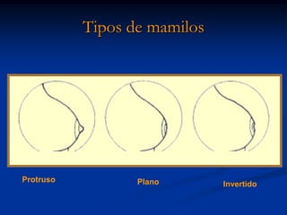 Tipos de mamilos




Protruso          Plano       Invertido
 
