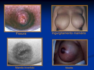 Fissura            Ingurgitamento mamário




Mamilo invertido           Mastite
 