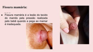 ● Fissura mamária é a lesão do tecido
do mamilo pela pressão realizada
pelo bebê quando a pega ao mamar
é inadequada.
Fissura mamária:
 
