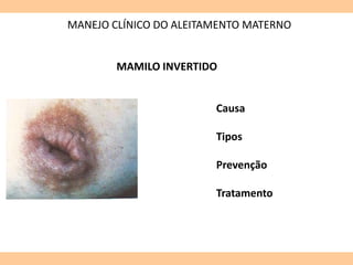 MANEJO CLÍNICO DO ALEITAMENTO MATERNO
MAMILO INVERTIDO
Causa
Tipos
Prevenção
Tratamento
 
