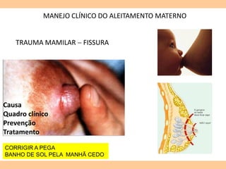 MANEJO CLÍNICO DO ALEITAMENTO MATERNO
Causa
Quadro clínico
Prevenção
Tratamento
TRAUMA MAMILAR  FISSURA
CORRIGIR A PEGA
BANHO DE SOL PELA MANHÃ CEDO
 