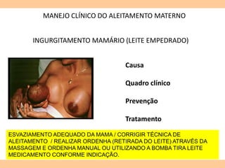 MANEJO CLÍNICO DO ALEITAMENTO MATERNO
INGURGITAMENTO MAMÁRIO (LEITE EMPEDRADO)
Causa
Quadro clínico
Prevenção
Tratamento
ESVAZIAMENTO ADEQUADO DA MAMA / CORRIGIR TÉCNICA DE
ALEITAMENTO / REALIZAR ORDENHA (RETIRADA DO LEITE) ATRAVÉS DA
MASSAGEM E ORDENHA MANUAL OU UTILIZANDO A BOMBA TIRA LEITE
MEDICAMENTO CONFORME INDICAÇÃO.
 