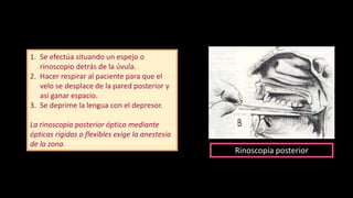 1. Se efectúa situando un espejo o
rinoscopio detrás de la úvula.
2. Hacer respirar al paciente para que el
velo se desplace de la pared posterior y
así ganar espacio.
3. Se deprime la lengua con el depresor.
La rinoscopia posterior óptica mediante
ópticas rígidas o flexibles exige la anestesia
de la zona.
Rinoscopía posterior
 