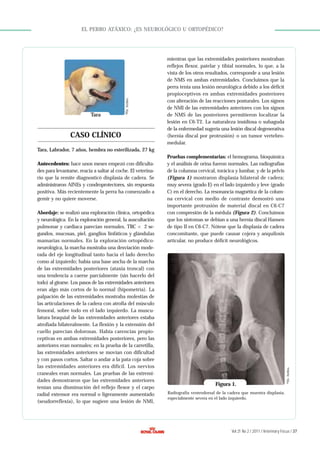 Tara

©Dr. Artiles.

EL PERRO ATÁXICO: ¿ES NEUROLÓGICO U ORTOPÉDICO?

CASO CLÍNICO

mientras que las extremidades posteriores mostraban
reflejos flexor, patelar y tibial normales, lo que, a la
vista de los otros resultados, corresponde a una lesión
de NMS en ambas extremidades. Concluimos que la
perra tenía una lesión neurológica debido a los déficit
propioceptivos en ambas extremidades posteriores
con alteración de las reacciones posturales. Los signos
de NMI de las extremidades anteriores con los signos
de NMS de las posteriores permitieron localizar la
lesión en C6-T2. La naturaleza insidiosa o subaguda
de la enfermedad sugería una lesión discal degenerativa
(hernia discal por protrusión) o un tumor vertebromedular.

Tara, Labrador, 7 años, hembra no esterilizada, 27 kg

Abordaje: se realizó una exploración clínica, ortopédica
y neurológica. En la exploración general, la auscultación
pulmonar y cardiaca parecían normales, TRC < 2 segundos, mucosas, piel, ganglios linfáticos y glándulas
mamarias normales. En la exploración ortopédiconeurológica, la marcha mostraba una desviación moderada del eje longitudinal tanto hacia el lado derecho
como al izquierdo; había una base ancha de la marcha
de las extremidades posteriores (ataxia troncal) con
una tendencia a caerse parcialmente (sin hacerlo del
todo) al girarse. Los pasos de las extremidades anteriores
eran algo más cortos de lo normal (hipometría). La
palpación de las extremidades mostraba molestias de
las articulaciones de la cadera con atrofia del músculo
femoral, sobre todo en el lado izquierdo. La musculatura braquial de las extremidades anteriores estaba
atrofiada bilateralmente. La flexión y la extensión del
cuello parecían dolorosas. Había carencias propioceptivas en ambas extremidades posteriores, pero las
anteriores eran normales; en la prueba de la carretilla,
las extremidades anteriores se movían con dificultad
y con pasos cortos. Saltar o andar a la pata coja sobre
las extremidades anteriores era difícil. Los nervios
craneales eran normales. Las pruebas de las extremidades demostraron que las extremidades anteriores
tenían una disminución del reflejo flexor y el carpo
radial extensor era normal o ligeramente aumentado
(seudorreflexia), lo que sugiere una lesión de NMI,

Pruebas complementarias: el hemograma, bioquímica
y el análisis de orina fueron normales. Las radiografías
de la columna cervical, torácica y lumbar, y de la pelvis
(Figura 1) mostraron displasia bilateral de cadera;
muy severa (grado E) en el lado izquierdo y leve (grado
C) en el derecho. La resonancia magnética de la columna cervical con medio de contraste demostró una
importante protrusión de material discal en C6-C7
con compresión de la médula (Figura 2). Concluimos
que los síntomas se debían a una hernia discal Hansen
de tipo II en C6-C7. Nótese que la displasia de cadera
concomitante, que puede causar cojera y anquilosis
articular, no produce déficit neurológicos.

Figura 1.

© Dr. Artiles.

Antecedentes: hace unos meses empezó con dificultades para levantarse, reacia a saltar al coche. El veterinario que la remite diagnosticó displasia de cadera. Se
administraron AINEs y condroprotectores, sin respuesta
positiva. Más recientemente la perra ha comenzado a
gemir y no quiere moverse.

Radiografía ventrodorsal de la cadera que muestra displasia,
especialmente severa en el lado izquierdo.

Vol 21 No 2 / 2011 / Veterinary Focus / 37

 