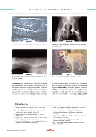 Figura 2.

©Dr. Artiles.

©Dr. Artiles.

EL PERRO ATÁXICO: ¿ES NEUROLÓGICO U ORTOPÉDICO?

Figura 3.

Radiografía postoperatoria que muestra reposición total de la
cadera izquierda.

© Dr. Artiles.

© Dr. Artiles.

RMN cervical que muestra compresión medular en C6-C7.

Figura 4.

Figura 5.

Radiografía postoperatoria que muestra estabilización de las
vértebras cervicales.

Tara 2 semanas después de la reposición de cadera.

Tratamiento: tras hablarlo con el propietario, se acordó
tratar primero el disco y luego (dependiendo de los
resultados) considerar la displasia de cadera. Se realizó
una fenestración y se practicó una ranura ventral del
espacio vertebral, estabilizando la zona con tornillos y
cemento de polimetacrilato (Figura 3); y la recupe-

ración postoperatoria fue muy buena. Seis meses más
tarde se realizó una sustitución total de la cadera
izquierda (Figura 4) y, aunque la prótesis tuvo que
modificarse a los 2 meses, ahora está completamente
integrada y el estado general de Tara es normal desde un
punto de vista ortopédico y neurológico (Figura 5).

BIBLIOGRAFÍA
1. Lorenzo V, Bernardini M. In: Neurología del perro y del gato. 1st ed.
Buenos Aires, Intermédica, 2007;42-63.

6. Cuddon P. The neurologic examination in small animals. In: Proceedings.
European Veterinary Conference 2009, Voorjaarsdagen, Amsterdam.

2. De Lahunta A, Glass E. In: Veterinary neuroanatomy and clinical
neurology. 3rd ed. St Louis, Saunders, 2009;222-230.

7. Penderis J. Localising spinal cord and peripheral nerve lesions. In:
Proceedings. European Veterinary Conference 2010, Voorjaarsdagen,
Amsterdam.

3. Dietz V. Propioception and locomotors disorders. Nat Rev Neuro
2002;3:781-790.
4. Jaggy A, Spiess B. Neurologic examination of small animals. In: Small
animal neurology. 2010. Hannover, Schlütersche; 8-9.
5. Cochrane S. A practical approach to the abnormal gait: is it orthopedic or
neurologic? In: Proceedings. WSAVA Congress 2007.

38 / Veterinary Focus / Vol 21 No 1 / 2011

8. Cuddon P. Myopathy I-II. In: Proceedings. European Veterinary Conference
2009, Voorjaarsdagen, Amsterdam.
9. Lorenzo V, Bernardini M. In: Neurología del perro y del gato. 1st ed.
Buenos Aires, Intermédica 2007;114-116.
10. Lang J, Konar M. MRI of the musculoskeletal system. In: Proceedings
WSAVA 2006;286-287.

 