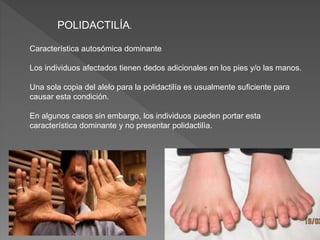 Característica autosómica dominante
Los individuos afectados tienen dedos adicionales en los pies y/o las manos.
Una sola copia del alelo para la polidactilía es usualmente suficiente para
causar esta condición.
En algunos casos sin embargo, los individuos pueden portar esta
característica dominante y no presentar polidactilìa.
POLIDACTILÍA.
 