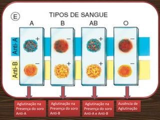 Aglutinação na     Aglutinação na     Aglutinação na     Ausência de
Presença do soro   Presença do soro   Presença do soro   Aglutinação
Anti-A             Anti-B             Anti-A e Anti-B
 