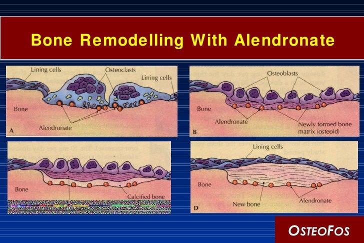 Alendronate Fosamax Osteoporosis