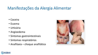 Manifestações da Alergia Alimentar
• Coceira
• Eczema
• Urticária
• Angioedema
• Sintomas gastrointestinais
• Sintomas respiratórios
• Anafilaxia – choque anafilático
 