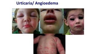Urticaria/ Angioedema
 