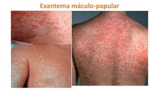 Exantema máculo-papular
 