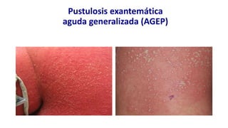 Pustulosis exantemática
aguda generalizada (AGEP)
 