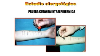 PRUEBA CUTANEA INTRAEPIDERMICA
 