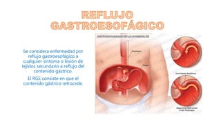 Se considera enfermedad por
reflujo gastroesofágico a
cualquier síntoma o lesión de
tejidos secundario a reflujo del
contenido gástrico.
El RGE consiste en que el
contenido gástrico retrocede.
 