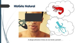 História NaturalHistória Natural
A alergia alimentar à frutos do mar tende a persistir......
 
