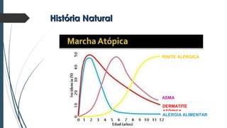 História NaturalHistória Natural
RINITE ALÉRGICA
ASMA
DERMATITE
ATÓPICA
ALERGIA ALIMENTAR
 
