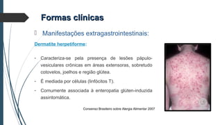  Manifestações extragastrointestinais:
Dermatite herpetiforme:
- Caracteriza-se pela presença de lesões pápulo-
vesiculares crônicas em áreas extensoras, sobretudo
cotovelos, joelhos e região glútea.
- É mediada por células (linfócitos T).
- Comumente associada à enteropatia glúten-induzida
assintomática.
Formas clínicasFormas clínicas
Consenso Brasileiro sobre Alergia Alimentar 2007
 