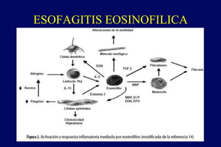 ESOFAGITIS EOSINOFILICA
 