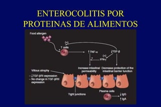 ENTEROCOLITIS POR
PROTEINAS DE ALIMENTOS
 