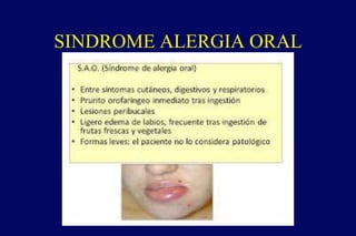 SINDROME ALERGIA ORAL
 