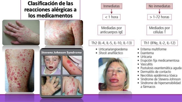 Alergia a medicamentos