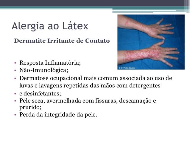 Alergia Ao Látex: Sintomas, Causas E Como Tratar – RENCQ