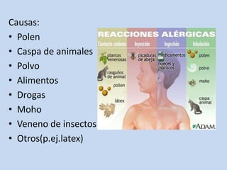 Causas:
• Polen
• Caspa de animales
• Polvo
• Alimentos
• Drogas
• Moho
• Veneno de insectos
• Otros(p.ej.latex)
 