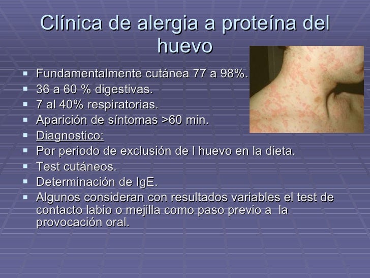 alergias en pediatria