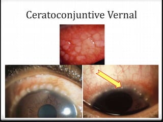 Ceratoconjuntive Vernal
 