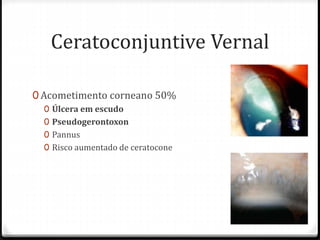 Ceratoconjuntive Vernal
0 Acometimento corneano 50%
0 Úlcera em escudo
0 Pseudogerontoxon
0 Pannus
0 Risco aumentado de ceratocone
 