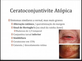 0 Sintomas similares a vernal, mas mais graves
0 Alteração cutânea / queratinização da margem
0 Sinal de Hertoghe's (ou sinal da rainha Anne)
0Madarose do 1/3 temporal
0 Conjuntiva tarsal inferior
0 Simbléfaro
0 Ceratocone em 15%
0 Catarata / descolamento retina
Ceratoconjuntivite Atópica
 