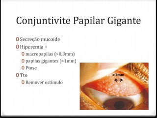 Conjuntivite Papilar Gigante
0 Secreção mucoide
0 Hiperemia +
0 macropapilas (>0,3mm)
0 papilas gigantes (>1mm)
0 Ptose
0 Tto
0 Remover estímulo
>1mm
 