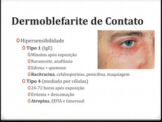 Dermoblefarite de Contato
0 Hipersensibilidade
0 Tipo 1 (IgE)
0Minutos após exposição
0Raramente, anafilaxia
0Edema + quemose
0Bacitracina, cefalosporinas, penicilina, maquiagem
0 Tipo 4 (mediada por células)
024-72 horas após exposição
0Eritema + descamação
0Atropina, EDTA e timerosal
 