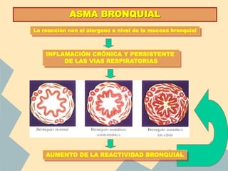 ASMA BRONQUIAL
INFLAMACIÓN CRÓNICA Y PERSISTENTE
DE LAS VIAS RESPIRATORIAS
AUMENTO DE LA REACTIVIDAD BRONQUIAL
La reacción con el alergeno a nivel de la mucosa bronquial
 