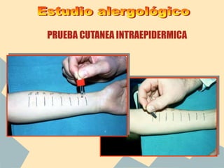 PRUEBA CUTANEA INTRAEPIDERMICA
 
