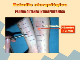 PRUEBA CUTANEA INTRAEPIDERMICA
+
Diámetro
 3 mm
15 minutos
 