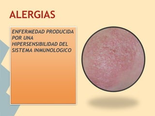 ALERGIAS
ENFERMEDAD PRODUCIDA
POR UNA
HIPERSENSIBILIDAD DEL
SISTEMA INMUNOLOGICO
 