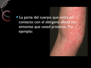 La parte del cuerpo que entra en
contacto con el alérgeno afecta los
síntomas que usted presenta. Por
ejemplo:
 
