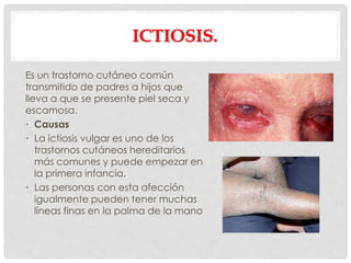 ICTIOSIS.
Es un trastorno cutáneo común
transmitido de padres a hijos que
lleva a que se presente piel seca y
escamosa.
• Causas
• La ictiosis vulgar es uno de los
trastornos cutáneos hereditarios
más comunes y puede empezar en
la primera infancia.
• Las personas con esta afección
igualmente pueden tener muchas
líneas finas en la palma de la mano
 