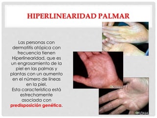 HIPERLINEARIDAD PALMAR
Las personas con
dermatitis atópica con
frecuencia tienen
Hiperlinearidad, que es
un engrosamiento de la
piel en las palmas y
plantas con un aumento
en el número de líneas
en la piel.
Esta característica está
estrechamente
asociada con
predisposición genética.
 