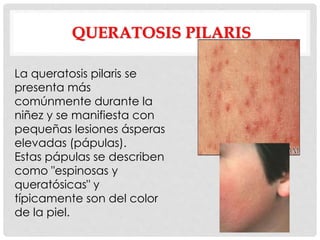 QUERATOSIS PILARIS
La queratosis pilaris se
presenta más
comúnmente durante la
niñez y se manifiesta con
pequeñas lesiones ásperas
elevadas (pápulas).
Estas pápulas se describen
como "espinosas y
queratósicas" y
típicamente son del color
de la piel.
 