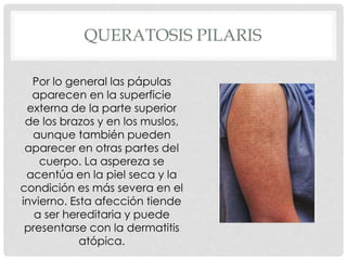 QUERATOSIS PILARIS
Por lo general las pápulas
aparecen en la superficie
externa de la parte superior
de los brazos y en los muslos,
aunque también pueden
aparecer en otras partes del
cuerpo. La aspereza se
acentúa en la piel seca y la
condición es más severa en el
invierno. Esta afección tiende
a ser hereditaria y puede
presentarse con la dermatitis
atópica.
 