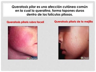 Queratosis pilaris rubra faceii Queratosis pilaris de la mejilla
Queratosis pilar es una afección cutánea común
en la cual la queratina, forma tapones duros
dentro de los folículos pilosos.
 