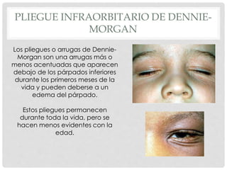 PLIEGUE INFRAORBITARIO DE DENNIE-
MORGAN
Los pliegues o arrugas de Dennie-
Morgan son una arrugas más o
menos acentuadas que aparecen
debajo de los párpados inferiores
durante los primeros meses de la
vida y pueden deberse a un
edema del párpado.
Estos pliegues permanecen
durante toda la vida, pero se
hacen menos evidentes con la
edad.
 