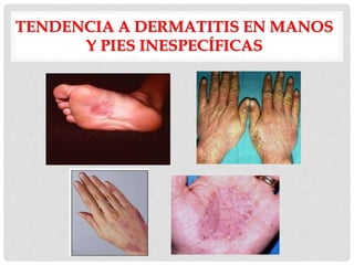 TENDENCIA A DERMATITIS EN MANOS
Y PIES INESPECÍFICAS
 