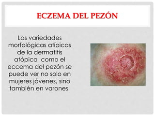 ECZEMA DEL PEZÓN
Las variedades
morfológicas atípicas
de la dermatitis
atópica como el
eccema del pezón se
puede ver no solo en
mujeres jóvenes, sino
también en varones
 