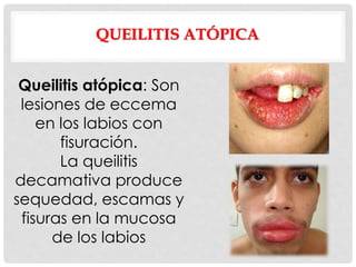 QUEILITIS ATÓPICA
Queilitis atópica: Son
lesiones de eccema
en los labios con
fisuración.
La queilitis
decamativa produce
sequedad, escamas y
fisuras en la mucosa
de los labios
 